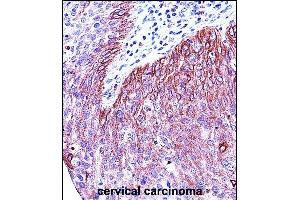 KRT6B Antibody (Center) (ABIN657654 and ABIN2846649) immunohistochemistry analysis in formalin fixed and paraffin embedded human cervical carcinoma followed by peroxidase conjugation of the secondary antibody and DAB staining. (Keratin 6B 抗体  (AA 207-236))