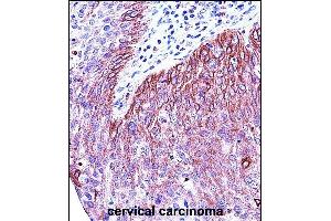 KRT6B Antibody (Center) (ABIN657654 and ABIN2846649) immunohistochemistry analysis in formalin fixed and paraffin embedded human cervical carcinoma followed by peroxidase conjugation of the secondary antibody and DAB staining.