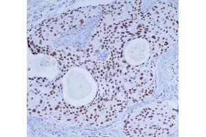 Immunohistochemical analysis of paraffin-embedded Breast cancer using DNA-PKcs mouse mAb (1/200 dilution). (PRKDC 抗体)