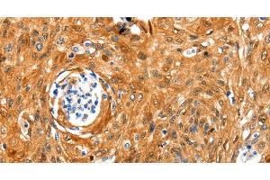 Immunohistochemistry of paraffin-embedded Human cervical cancer tissue using NCOR1 Polyclonal Antibody at dilution 1:100 (NCOR1 抗体)