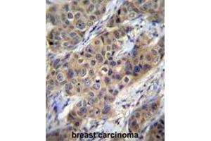 TGFB1 Antibody (N-term) immunohistochemistry analysis in formalin fixed and paraffin embedded human breast carcinoma followed by peroxidase conjugation of the secondary antibody and DAB staining.