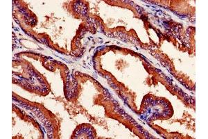 Immunohistochemistry of paraffin-embedded human prostate cancer using ABIN7161940 at dilution of 1:100 (NXF5 抗体  (AA 1-200))