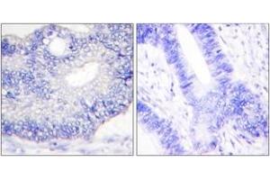 Immunohistochemistry analysis of paraffin-embedded human colon carcinoma tissue, using TGF alpha Antibody. (TGFA 抗体  (AA 111-160))