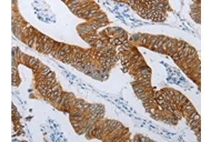 The image on the left is immunohistochemistry of paraffin-embedded Human colon cancer tissue using ABIN7192809(TMEM8B Antibody) at dilution 1/15, on the right is treated with synthetic peptide. (TMEM8B 抗体)