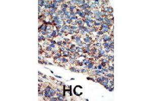 Formalin-fixed and paraffin-embedded human hepatocellular carcinoma tissue reacted with PIK3C2G polyclonal antibody  , which was peroxidase-conjugated to the secondary antibody, followed by AEC staining. (PIK3C2G 抗体  (N-Term))