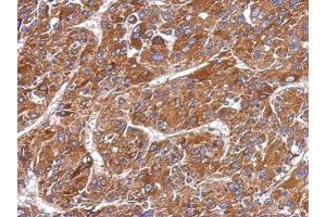 IHC-P Image Immunohistochemical analysis of paraffin-embedded human hepatoma, using MMP8, antibody at 1:500 dilution. (MMP8 抗体)