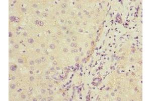 Immunohistochemistry of paraffin-embedded human liver cancer using ABIN7148298 at dilution of 1:100 (COMMD1 抗体  (AA 1-190))