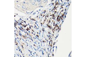 Immunohistochemistry of paraffin-embedded Human esophageal cancer using CD3H antibody (ABIN3022812, ABIN3022813, ABIN3022814 and ABIN6219240) at dilution of 1:100 (40x lens).