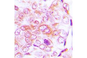 Immunohistochemical analysis of BMP5 staining in human lung cancer formalin fixed paraffin embedded tissue section. (BMP5 抗体  (Center))
