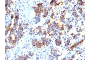 Formalin-fixed, paraffin-embedded human Gastric Carcinoma stained with MUC5AC Mouse Monoclonal Antibody (45M1). (MUC5AC 抗体)