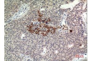 Immunohistochemistry (IHC) analysis of paraffin-embedded Human Breast Cancer, antibody was diluted at 1:100. (STING/TMEM173 抗体  (C-Term))