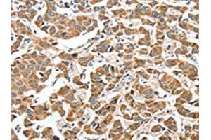 The image on the left is immunohistochemistry of paraffin-embedded Human breast cancer tissue using ABIN7189774(ALDH9A1 Antibody) at dilution 1/50, on the right is treated with synthetic peptide. (ALDH9A1 抗体)