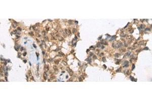 Immunohistochemistry of paraffin-embedded Human ovarian cancer tissue using ATRX Polyclonal Antibody at dilution of 1:50(x200) (ATRX 抗体)