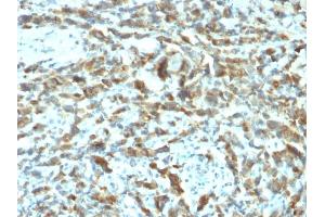Formalin-fixed, paraffin-embedded human Breast Carcinoma stained with TFF1/pS2 Mouse Monoclonal Antibody (TFF1/2133). (TFF1 抗体)