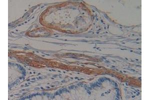 Detection of NT-ProANP in Human Colorectal cancer Tissue using Polyclonal Antibody to N-Terminal Pro-Atrial Natriuretic Peptide (NT-ProANP) (PRO-ANP 抗体  (AA 25-123))