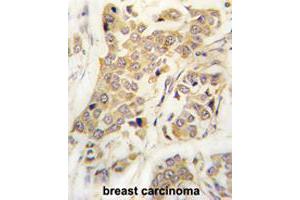 Formalin-fixed and paraffin-embedded human breast carcinomareacted with CDH8 polyclonal antibody , which was peroxidase-conjugated to the secondary antibody, followed by AEC staining. (Cadherin 8 抗体  (N-Term))