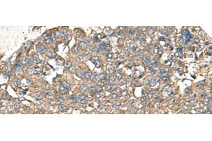 Immunohistochemistry of paraffin-embedded Human liver cancer tissue using RPS14 Polyclonal Antibody at dilution of 1:50(x200) (RPS14 抗体)