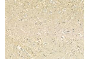 ABIN6260529 and ABIN6279318 at 1/100 staining human glioblastoma by IHC-P. (CCDC8 抗体  (N-Term))