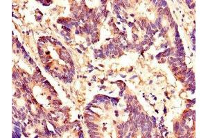 Immunohistochemistry of paraffin-embedded human colon cancer using ABIN7155909 at dilution of 1:100 (HCFC1 抗体  (AA 201-428))