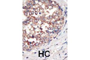 Formalin-fixed and paraffin-embedded human hepatocellular carcinoma tissue reacted with PIK3CG polyclonal antibody  , which was peroxidase-conjugated to the secondary antibody, followed by AEC staining. (PIK3 gamma 抗体  (C-Term))