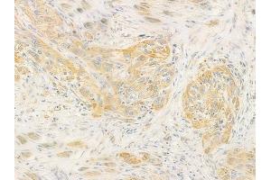 ABIN6260159 and ABIN6278363 at 1/100 staining human tongue carcinoma by IHC-P. (AVPR1A 抗体  (C-Term))