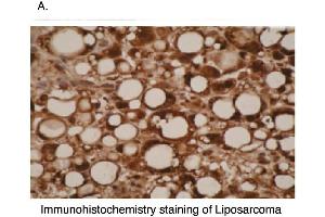 Immunohistochemical staining of liposarcoma cells using CYP26A1  antibody . (CYP26A1 抗体  (C-Term))