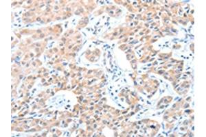 The image on the left is immunohistochemistry of paraffin-embedded Human lung cancer tissue using ABIN7128233(ADAM21 Antibody) at dilution 1/15, on the right is treated with fusion protein. (ADAM21 抗体)