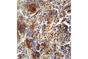 ZNF30 antibody (N-term) immunohistochemistry analysis in formalin fixed and paraffin embedded human lung carcinoma followed by peroxidase conjugation of the secondary antibody and DAB staining. (ZFP30 抗体  (N-Term))