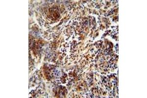 ZNF30 antibody (N-term) immunohistochemistry analysis in formalin fixed and paraffin embedded human lung carcinoma followed by peroxidase conjugation of the secondary antibody and DAB staining.