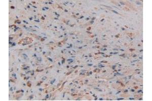 IHC-P analysis of Human Prostate Gland Cancer Tissue, with DAB staining. (Lipocalin 2 抗体  (AA 21-198))