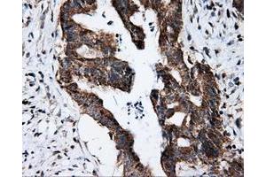 Immunohistochemical staining of paraffin-embedded Adenocarcinoma of colon tissue using anti-FKBP1A mouse monoclonal antibody. (FKBP1A 抗体)