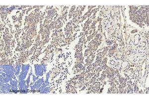 Immunohistochemical analysis of paraffin-embedded human lung cancer tissue. (p53 抗体)