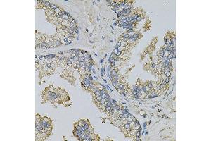 Immunohistochemistry of paraffin-embedded human prostate using PSAT1 Antibody (ABIN6293473) at dilution of 1:100 (40x lens). (PSAT1 抗体)