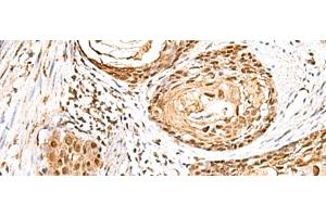 Immunohistochemistry of paraffin-embedded Human esophagus cancer tissue using ELF3 Polyclonal Antibody at dilution of 1:95(x200) (ELF3 抗体)