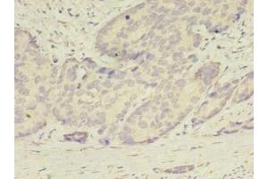 Immunohistochemistry of paraffin-embedded human gastric cancer using ABIN7145113 at dilution of 1:100 (ATG2B 抗体  (AA 1357-1536))