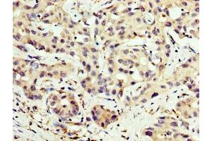 IHC image of ABIN7146841 diluted at 1:200 and staining in paraffin-embedded human liver cancer performed on a Leica BondTM system. (CPT2 抗体  (AA 388-551))