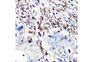 Immunohistochemistry of paraffin-embedded human colon carcinoma using FSP1/S100 Rabbit mAb (ABIN7270125) at dilution of 1:100 (40x lens). (s100a4 抗体)