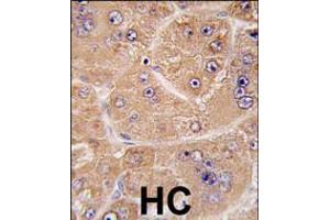 Formalin-fixed and paraffin-embedded human hepatocarcinoma tissue reacted with FUCA2 antibody , which was peroxidase-conjugated to the secondary antibody, followed by DAB staining. (FUCA2 抗体  (N-Term))