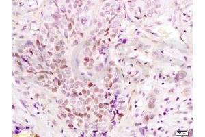 Formalin-fixed and paraffin embedded human esophageal carcinoma labeled with Anti-PAX3 Polyclonal Antibody, Unconjugated (ABIN737616) at 1:200 followed by conjugation to the secondary antibody and DAB staining (Paired Box 3 抗体  (AA 151-250))