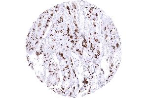 Colon Colorectal adenocarcinoma with TOPO2A immunostaining in _50 of tumor cells