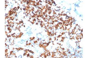 Formalin-fixed, paraffin-embedded human Gastric Carcinoma stained with IL3RA/CD123 Mouse Monoclonal Antibody (IL3RA/1531). (IL3RA 抗体  (AA 26-171))