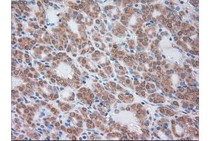 Immunohistochemical staining of paraffin-embedded Carcinoma of liver tissue using anti-SERPINA1mouse monoclonal antibody. (SERPINA1 抗体)
