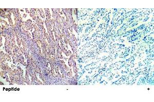 Immunohistochemical analysis of paraffin-embedded human lung carcinoma tissue using PRKAB1 polyclonal antibody . (PRKAB1 抗体  (Ser182))