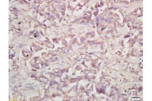 Formalin-fixed and paraffin embedded human lung carcinoma labeled with Rabbit Anti-V-ATPase A1 Polyclonal Antibody, Unconjugated (ABIN1387667) at 1:200 followed by conjugation to the secondary antibody and DAB staining (V-ATPase 116 kDa Isoform a1 (AA 41-140) 抗体)