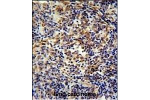 CASKIN2 Antibody (Center) (ABIN654902 and ABIN2844550) immunohistochemistry analysis in formalin fixed and paraffin embedded human lung carcinoma followed by peroxidase conjugation of the secondary antibody and DAB staining. (CASKIN2 抗体  (AA 714-741))