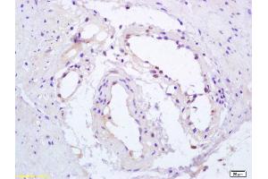 Formalin-fixed and paraffin embedded human gastric carcinoma labeled with Anti-Phospho-PPAR Gamma(ser112) Polyclonal Antibody, Unconjugated (ABIN703405) at 1:200, followed by conjugation to the secondary antibody and DAB staining (PPARG 抗体  (pSer112))