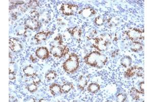 Formalin-fixed, paraffin-embedded human Gastric Carcinoma stained with SOX9 Mouse Monoclonal Antibody (SOX9/2387). (SOX9 抗体  (AA 393-508))