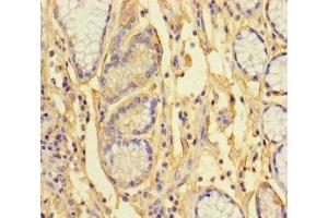 Immunohistochemistry of paraffin-embedded human gastric cancer using ABIN7163422 at dilution of 1:100 (ANKRD33 抗体  (AA 1-272))