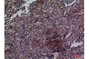 Immunohistochemistry (IHC) analysis of paraffin-embedded Human Lung Cancer, antibody was diluted at 1:100. (CDC34 抗体  (Internal Region))