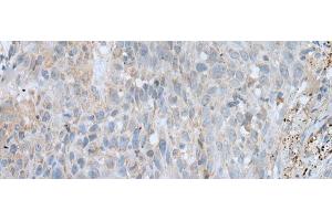 Immunohistochemistry of paraffin-embedded Human lung cancer tissue using VWA2 Polyclonal Antibody at dilution of 1:45(x200) (VWA2 抗体)